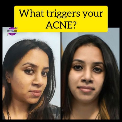 Observe what triggers your acne without falling for acne myths