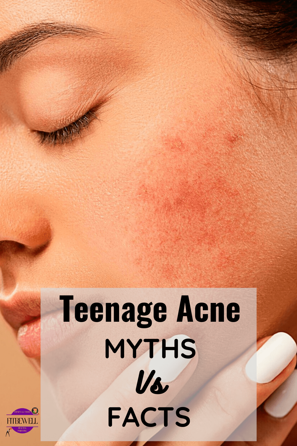 All you need to know about Teenage acne