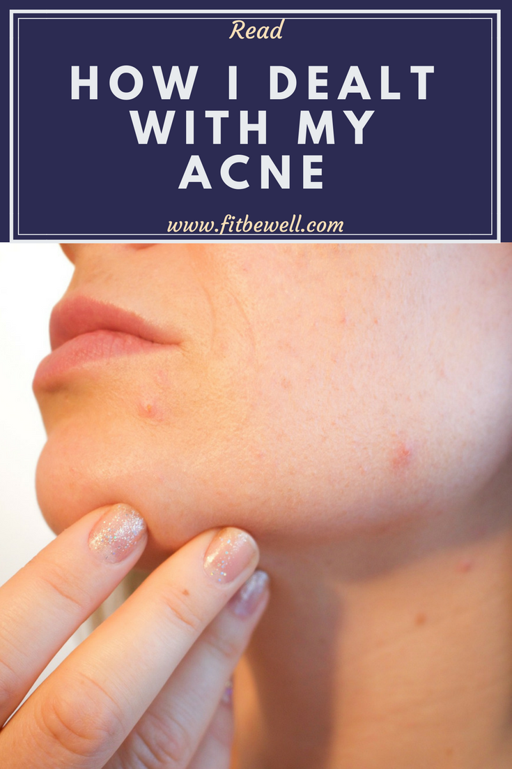 how i dealt with my acne. Shatter the stigma around any kind of acne around you, Check out how I helped myself rid acne